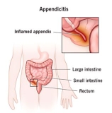 Yogic Remedies for Chronic Appendicitis