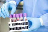 New Alzheimer’s Blood Test Leads To Early Detection And Treatment