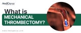 Mechanical thrombectomy: Procedure for stroke treatment