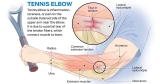 The Ultimate Guide for Tennis Elbow