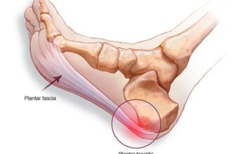 Ways to Help Plantar Fasciitis