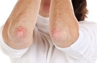 Top 6 Natural Homeopathic Remedies for Shingles and Herpes Treatment
