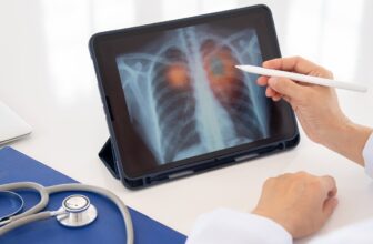 Optellum and Coreline Soft plan AI integration for lung nodule care