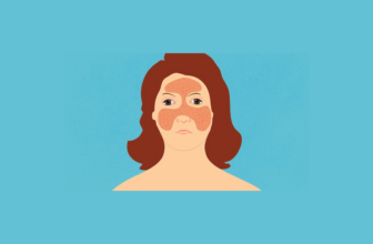 Can CBD Be Helpful in Treating Lupus?