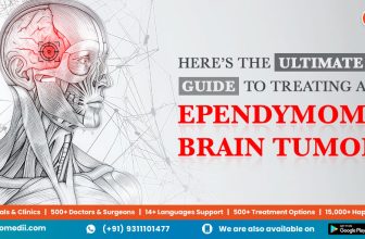 Here’s the Ultimate Guide to Treating An Ependymoma Brain Tumor