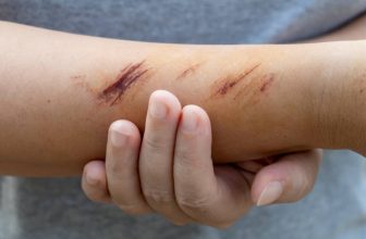 Top 11 Homeopathic Medicines For Treating Wounds and Injuries
