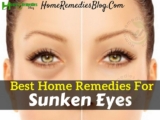 10 Best Home Remedies To Get Rid Of Sunken Eyes