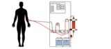 Dialysis Access Recirculation on Friday the 13th