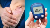 How To Reverse Type 2 Diabetes Naturally