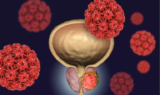 IMMUNOTHERAPY FOR PROSTATE CANCER WITH VDTP/GC-MAF – Healing Oracle
