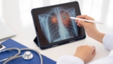 Optellum and Coreline Soft plan AI integration for lung nodule care