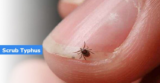Scrub Typhus Symptoms, Causes, Diagnosis
