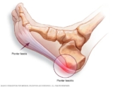 Ways to Help Plantar Fasciitis