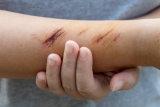 Top 11 Homeopathic Medicines For Treating Wounds and Injuries
